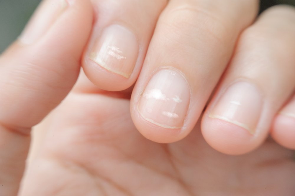 Как проблемы со здоровьем отражаются на ногтях?