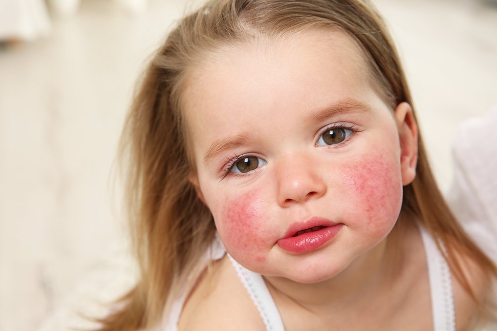 Пищевая аллергия или непереносимость: покраснение кожи, сыпь, зуд